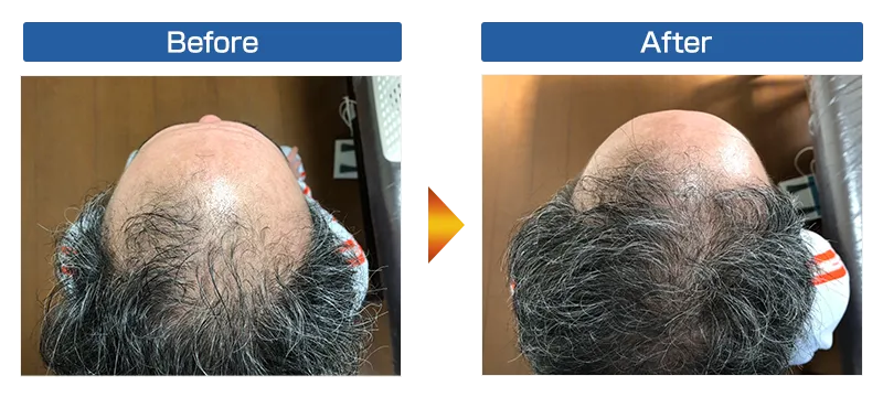 【発毛】50代男性