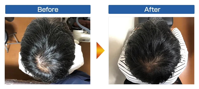 【発毛】40代前半男性