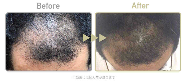 【発毛】ビフォーアフター